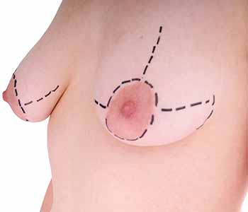 Manhattan area doctor offers breast repair surgery
