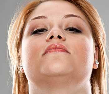 Fat Injections in the face