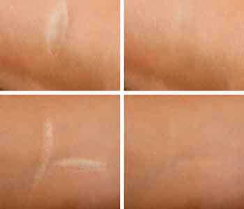 Treatments for Scars from Dr. Edmund Kwan