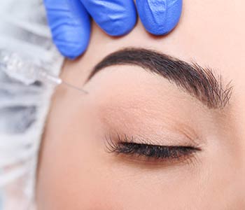 Dr. Kwan takes great care to avoid altering the height of the hairline while lifting the brow. 