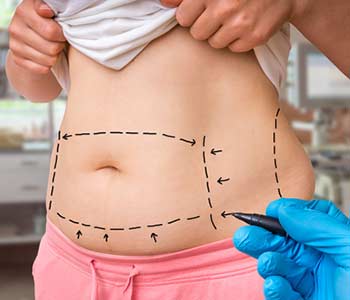 Plastic surgery doctor draw lines with marker on patient belly at clinic