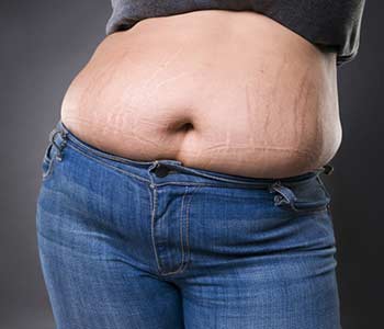 Woman with fat abdomen in blue jeans, overweight female stomach, stretch marks on belly