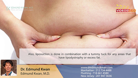 Tummy Tuck surgery NYC – Manhattan - Flushing - Edmund Kwan